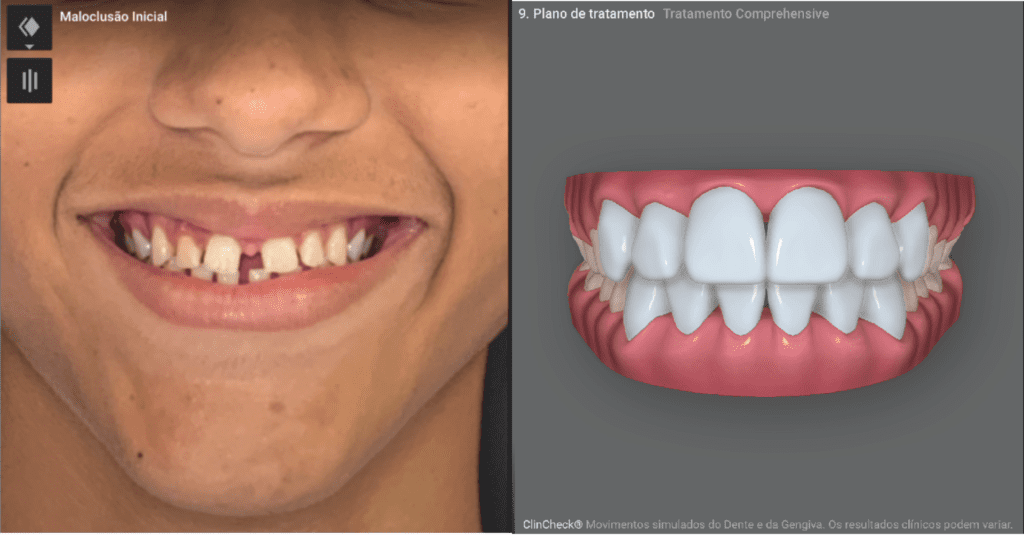A imagem mostra um rapaz em uma tela de computador escura, com foco em seu sorriso antes de iniciar a simulação do resultado final. A simulação é realizada pelo Invisalign Smile Architect.