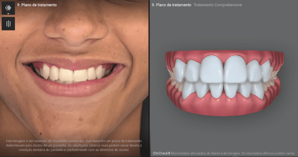 A imagem mostra um rapaz em uma tela de computador escura, com foco em seu sorriso depois de iniciar a simulação do resultado final. A simulação é realizada pelo Invisalign Smile Architect