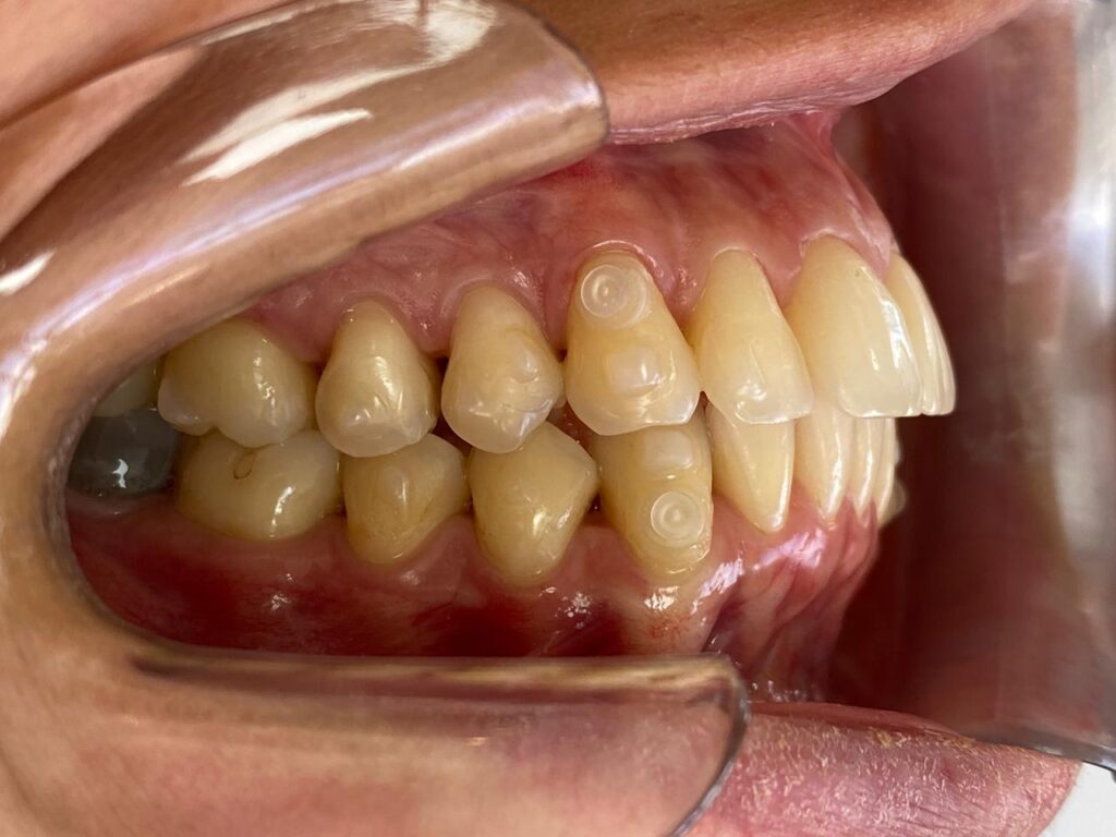 Nas duas imagens há uma moça com o óculos e cabelos preto. Ela está sorrindo. Na esquerda, sua foto é anterior ao tratamento e, na direita, posterior ao tratamento realizado com Invisalign®.