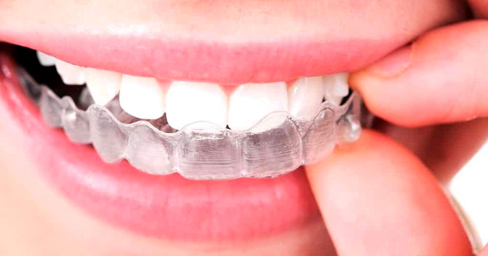Lado a lado um sorriso com Invisalign e um sorriso com aparelho ortodôntico convencional.